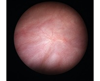 Normal bladder interior as seen during cystoscopy