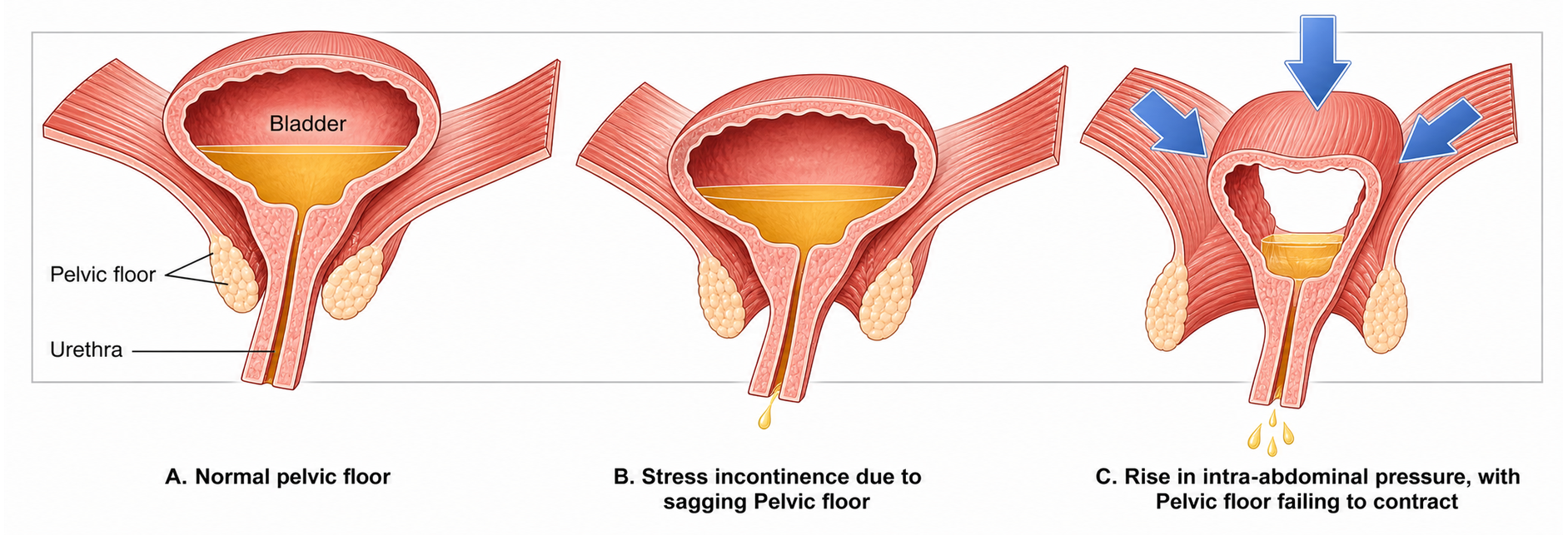 Weakened pelvic floor contributing to incontinence